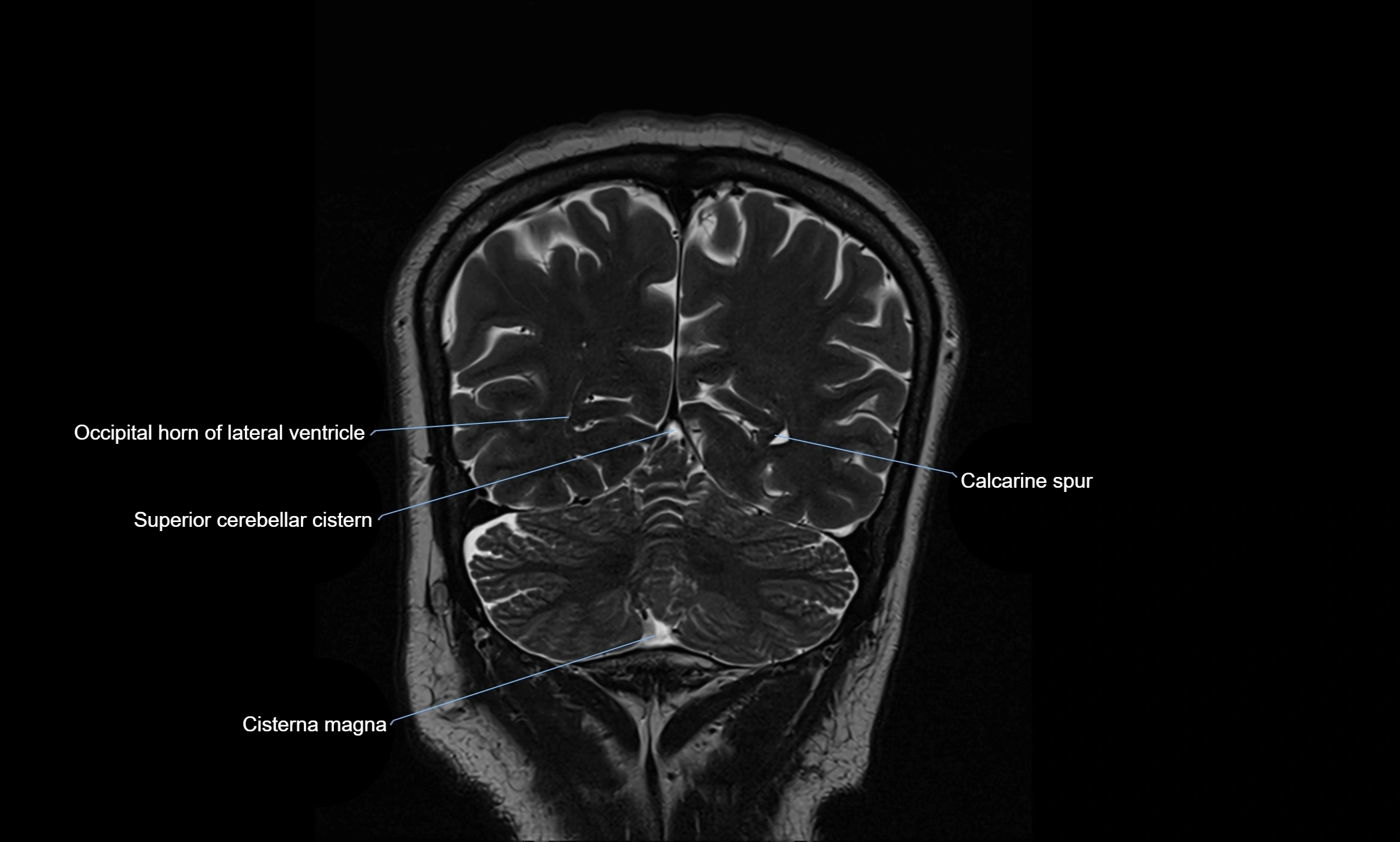 Brain cisterns  and ventricles coronal anatomy 3T MRI image-img-00001-00048.webp